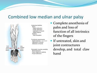 Combined low median and ulnar palsy
 Complete anesthesia of
palm and loss of
function of all intrinsics
of the fingers
 If untreated, skin and
joint contractures
develop, and total claw
hand
 