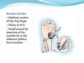 Riordon transfer
Sublimis tendon
of the ring finger
Pulley in FCU
Small tunnel for
insertion of the
transfer by in the
abductor pollicis
brevis tendon
 