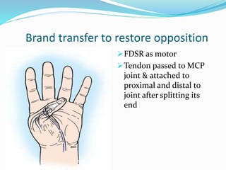 Brand transfer to restore opposition
FDSR as motor
Tendon passed to MCP
joint & attached to
proximal and distal to
joint after splitting its
end
 