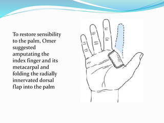 To restore sensibility
to the palm, Omer
suggested
amputating the
index finger and its
metacarpal and
folding the radially
innervated dorsal
flap into the palm
 