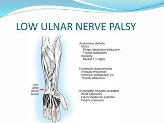 LOW ULNAR NERVE PALSY
 