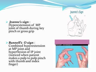  Jeanne’s sign :
Hyperextension of MP
joint of thumb during key
pinch or gross grip
 Bunnell’s O sign :
Combined hyperextension
at MP joint and
hyperflexion of IP joint
(noticed when patient
makes a pulp to pulp pinch
with thumb and index
finger)
 