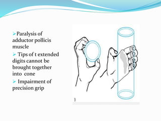 Paralysis of
adductor pollicis
muscle
 Tips of t extended
digits cannot be
brought together
into cone
 Impairment of
precision grip
 