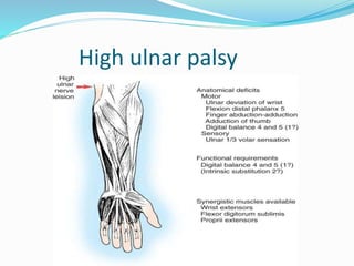 High ulnar palsy
 