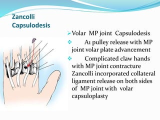 Zancolli
Capsulodesis
Volar MP joint Capsulodesis
 A1 pulley release with MP
joint volar plate advancement
 Complicated claw hands
with MP joint contracture
Zancolli incorporated collateral
ligament release on both sides
of MP joint with volar
capsuloplasty
 
