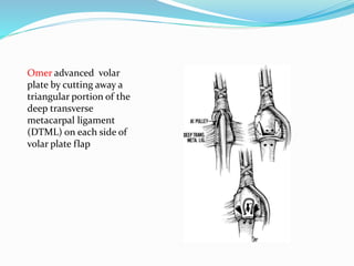 Omer advanced volar
plate by cutting away a
triangular portion of the
deep transverse
metacarpal ligament
(DTML) on each side of
volar plate flap
 