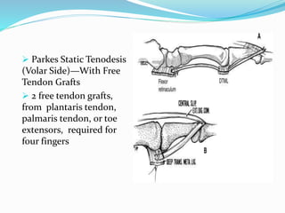  Parkes Static Tenodesis
(Volar Side)—With Free
Tendon Grafts
 2 free tendon grafts,
from plantaris tendon,
palmaris tendon, or toe
extensors, required for
four fingers
 