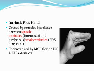  Intrinsic Plus Hand
 Caused by muscles imbalance
between spastic
intrinsics (interosseoi and
lumbricals)weak extrinsics (FDS,
FDP, EDC)
 Characterized by MCP flexion PIP
& DIP extension
 