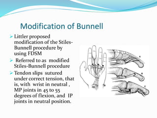 Modification of Bunnell
 Littler proposed
modification of the Stiles-
Bunnell procedure by
using FDSM
 Referred to as modified
Stiles-Bunnell procedure
 Tendon slips sutured
under correct tension, that
is, with wrist in neutral ,
MP joints in 45 to 55
degrees of flexion, and IP
joints in neutral position.
 