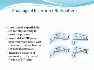 Phalangeal Insertion ( Burkhalter)
 Insertion of superficialis
tendon slips directly to
proximal phalanx
 Avoid risk of PIP joint
hyperextension noted with
transfers to lateral band of
the dorsal apparatus
 Increased distance of
moment with increased
flexion of MP joint
 
