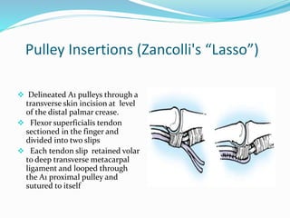 Pulley Insertions (Zancolli's “Lasso”)
 Delineated A1 pulleys through a
transverse skin incision at level
of the distal palmar crease.
 Flexor superficialis tendon
sectioned in the finger and
divided into two slips
 Each tendon slip retained volar
to deep transverse metacarpal
ligament and looped through
the A1 proximal pulley and
sutured to itself
 