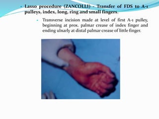  Lasso procedure (ZANCOLLI) - Transfer of FDS to A-1
pulleys, index, long, ring and small fingers.
 Transverse incision made at level of first A-1 pulley,
beginning at prox. palmar crease of index finger and
ending ulnarly at distal palmar crease of little finger.
 