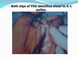Both slips of FDS identified distal to A-1
pulley.
 