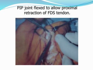 PIP joint flexed to allow proximal
retraction of FDS tendon.
 