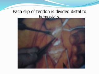 Each slip of tendon is divided distal to
hemostats.
 