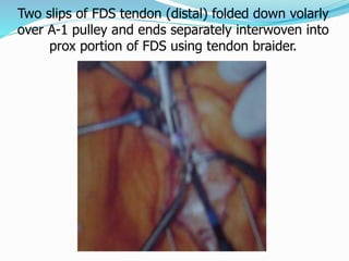 Two slips of FDS tendon (distal) folded down volarly
over A-1 pulley and ends separately interwoven into
prox portion of FDS using tendon braider.
 