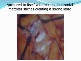 Anchored to itself with multiple horizontal
mattress stiches creating a strong lasso
 