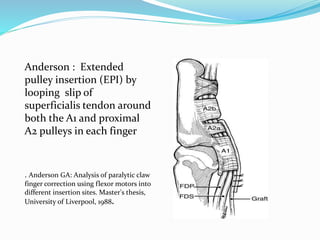 Anderson : Extended
pulley insertion (EPI) by
looping slip of
superficialis tendon around
both the A1 and proximal
A2 pulleys in each finger
. Anderson GA: Analysis of paralytic claw
finger correction using flexor motors into
different insertion sites. Master's thesis,
University of Liverpool, 1988.
 