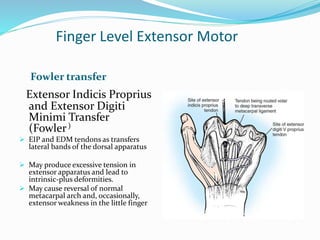 Finger Level Extensor Motor
Fowler transfer
Extensor Indicis Proprius
and Extensor Digiti
Minimi Transfer
(Fowler)
 EIP and EDM tendons as transfers
lateral bands of the dorsal apparatus
 May produce excessive tension in
extensor apparatus and lead to
intrinsic-plus deformities.
 May cause reversal of normal
metacarpal arch and, occasionally,
extensor weakness in the little finger
 