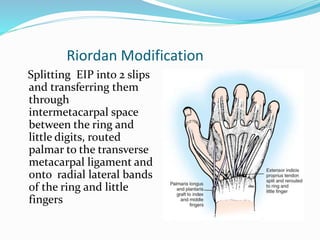 Riordan Modification
Splitting EIP into 2 slips
and transferring them
through
intermetacarpal space
between the ring and
little digits, routed
palmar to the transverse
metacarpal ligament and
onto radial lateral bands
of the ring and little
fingers
 