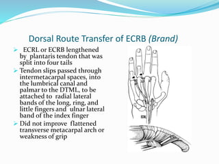Dorsal Route Transfer of ECRB (Brand)
 ECRL or ECRB lengthened
by plantaris tendon that was
split into four tails
 Tendon slips passed through
intermetacarpal spaces, into
the lumbrical canal and
palmar to the DTML, to be
attached to radial lateral
bands of the long, ring, and
little fingers and ulnar lateral
band of the index finger
 Did not improve flattened
transverse metacarpal arch or
weakness of grip
 