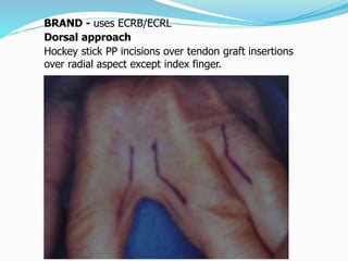 BRAND - uses ECRB/ECRL
Dorsal approach
Hockey stick PP incisions over tendon graft insertions
over radial aspect except index finger.
 