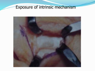 Exposure of intrinsic mechanism
 
