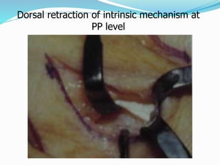 Dorsal retraction of intrinsic mechanism at
PP level
 