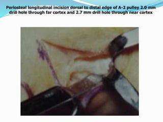 Periosteal longitudinal incision dorsal to distal edge of A-2 pulley 2.0 mm
drill hole through far cortex and 2.7 mm drill hole through near cortex
 