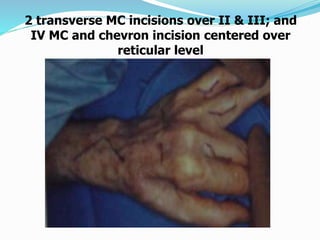 2 transverse MC incisions over II & III; and
IV MC and chevron incision centered over
reticular level
 