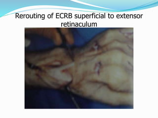 Rerouting of ECRB superficial to extensor
retinaculum
 