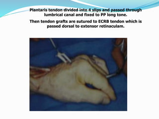 Plantaris tendon divided into 4 slips and passed through
lumbrical canal and fixed to PP long tone.
Then tendon grafts are sutured to ECRB tendon which is
passed dorsal to extensor retinaculam.
 