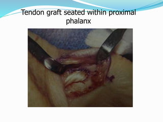 Tendon graft seated within proximal
phalanx
 