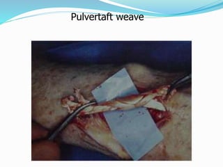 Pulvertaft weave
 