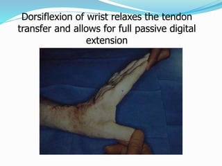 Dorsiflexion of wrist relaxes the tendon
transfer and allows for full passive digital
extension
 
