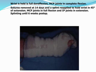 Wrist is held is full dorsiflexion, MCP joints in complete flexion.
Sutures removed at 14 days and a splint reapplied to hold wrist in 45°
of extension. MCP joints in full flexion and IP joints in extension.
Splinting until 6 weeks postop.
 