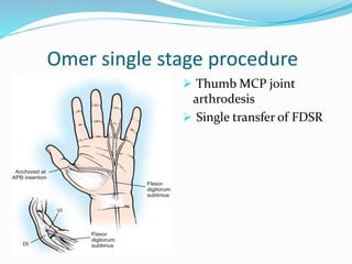 Omer single stage procedure
 Thumb MCP joint
arthrodesis
 Single transfer of FDSR
 