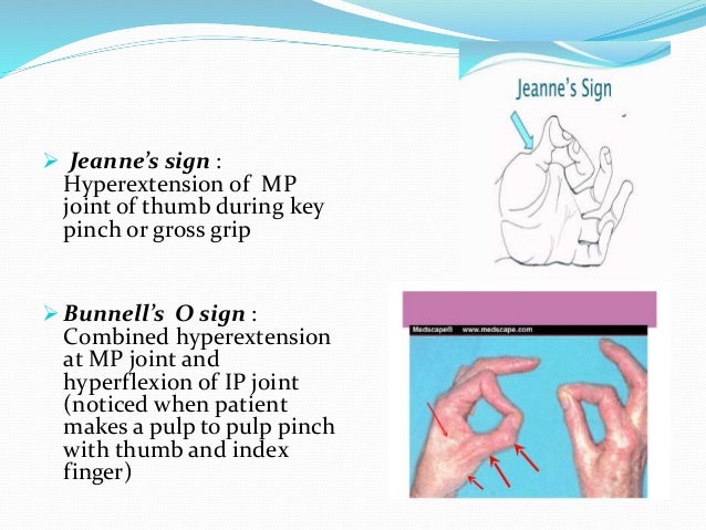 management of claw hand