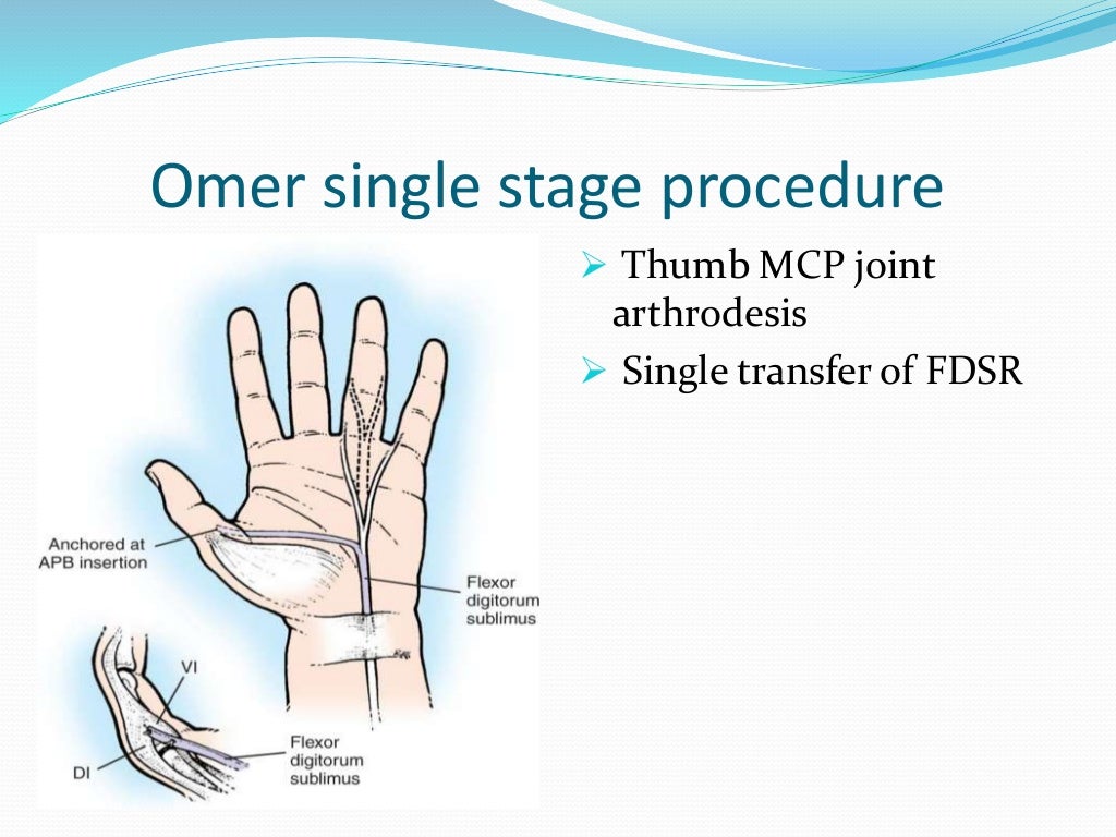 management of claw hand
