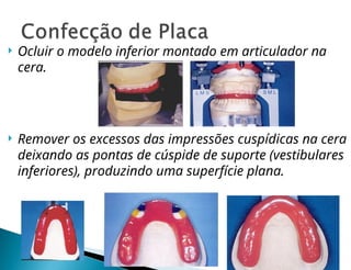  Ocluir o modelo inferior montado em articulador na
cera.
 Remover os excessos das impressões cuspídicas na cera
deixando as pontas de cúspide de suporte (vestibulares
inferiores), produzindo uma superfície plana.
 