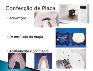  Acrilização
 Desinclusão da mufla
 Acabamento e polimento
 