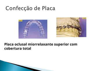 Placa oclusal miorrelaxante superior com
cobertura total
 