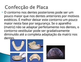  O contorno nos dentes posteriores pode ser um
pouco maior que nos dentes anteriores por motivos
estéticos. É melhor deixar este contorno um pouco
maior nesta fase por segurança. Se o aparelho
(matriz) não se adaptar perfeitamente nos dentes, o
contorno vestibular pode ser gradativamente
diminuído até a completa adaptação da matriz nos
dentes.
 