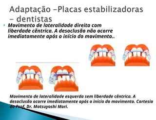  Movimento de lateralidade direita com
liberdade cêntrica. A desoclusão não ocorre
imediatamente após o início do movimento..
Movimento de lateralidade esquerda sem liberdade cêntrica. A
desoclusão ocorre imediatamente após o início do movimento. Cortesia
do Prof. Dr. Matsuyoshi Mori.
 