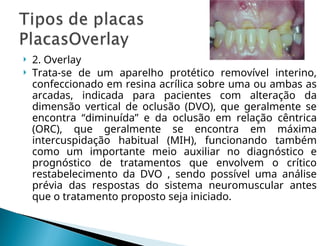  2. Overlay
 Trata-se de um aparelho protético removível interino,
confeccionado em resina acrílica sobre uma ou ambas as
arcadas, indicada para pacientes com alteração da
dimensão vertical de oclusão (DVO), que geralmente se
encontra “diminuída” e da oclusão em relação cêntrica
(ORC), que geralmente se encontra em máxima
intercuspidação habitual (MIH), funcionando também
como um importante meio auxiliar no diagnóstico e
prognóstico de tratamentos que envolvem o crítico
restabelecimento da DVO , sendo possível uma análise
prévia das respostas do sistema neuromuscular antes
que o tratamento proposto seja iniciado.
 