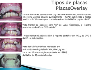 – Vista frontal de paciente com “Jig” deLucia modificado, confeccionado
em resina acrílica ativada quimicamente – RAAQ, submetido a testes
fonéticos de Silvemam para o restabelecimento da DVO e registro da RC.
 Vista frontal de paciente com “Jig” de Lucia modificado, e registro
posterior em RAAQ da DVO e da RC.
 – Vista frontal de paciente com o registro posterior em RAAQ da DVO e
da RC, restabelecidas.
 Vista frontal dos modelos montados em
 articulador semi-ajustável – ASA, com “Jig” de
 Lucia modificado, e registro posterior em RAAQ
 da DVO e da RC, restabelecidas.
 