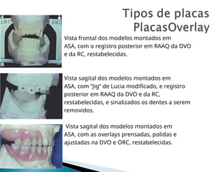  Vista frontal dos modelos montados em
 ASA, com o registro posterior em RAAQ da DVO
 e da RC, restabelecidas.
 Vista sagital dos modelos montados em
 ASA, com “Jig” de Lucia modificado, e registro
 posterior em RAAQ da DVO e da RC,
 restabelecidas, e sinalizados os dentes a serem
 removidos.
 Vista sagital dos modelos montados em
 ASA, com as overlays prensadas, polidas e
 ajustadas na DVO e ORC, restabelecidas.
 