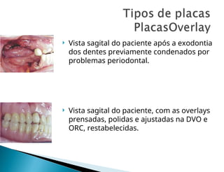  Vista sagital do paciente após a exodontia
dos dentes previamente condenados por
problemas periodontal.
 Vista sagital do paciente, com as overlays
prensadas, polidas e ajustadas na DVO e
ORC, restabelecidas.
 
