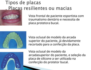 Vista frontal de paciente esportista com
traumatismo dentário e necessita de
placa protetora bucal.
Vista oclusal de modelo da arcada
superior do paciente, já devidamente
recortado para a confecção da placa.
Vista oclusal de modelo da
arcadasuperior do paciente, e seleção da
placa de silicone a ser utilizada na
confecção do protetor bucal.
 