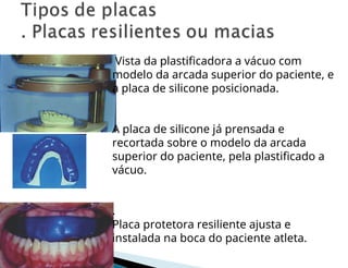 Vista da plastificadora a vácuo com
modelo da arcada superior do paciente, e
a placa de silicone posicionada.
A placa de silicone já prensada e
recortada sobre o modelo da arcada
superior do paciente, pela plastificado a
vácuo.
.
Placa protetora resiliente ajusta e
instalada na boca do paciente atleta.
 